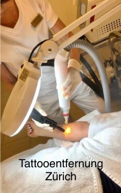 Picolaser Behandlung